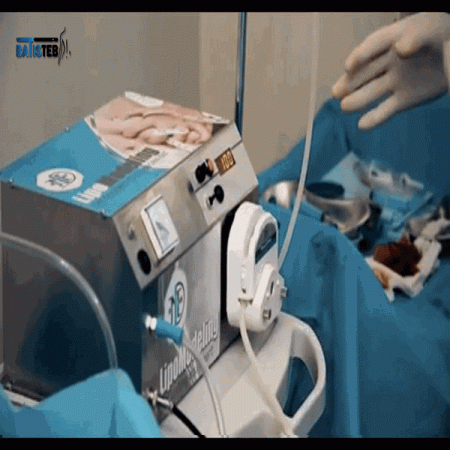 دستگاه لیپو مدلینگ چه ویژگی هایی دارد؟